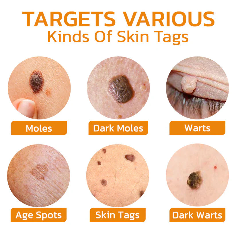 Méhméreg kezelő gél anyajegyekre és szemölcsökre