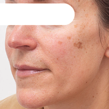 Gyógynövényes arcmaszk sötét foltokra