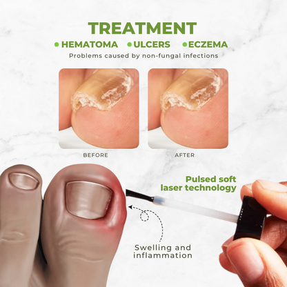 Körömkezelő olaj méhméreggel