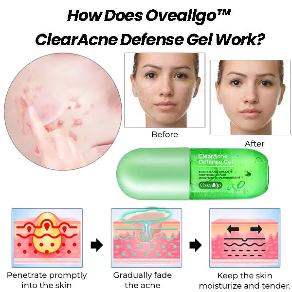 Gél pattanások és foltok ellen