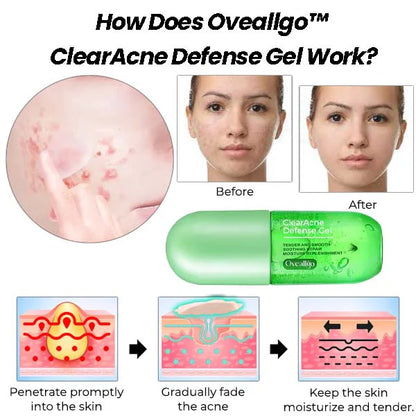 Gél pattanások és foltok ellen