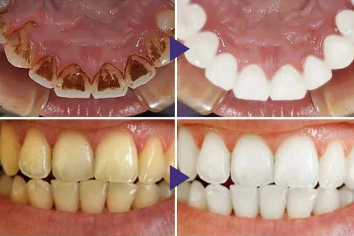 Fogíny kezelő gél