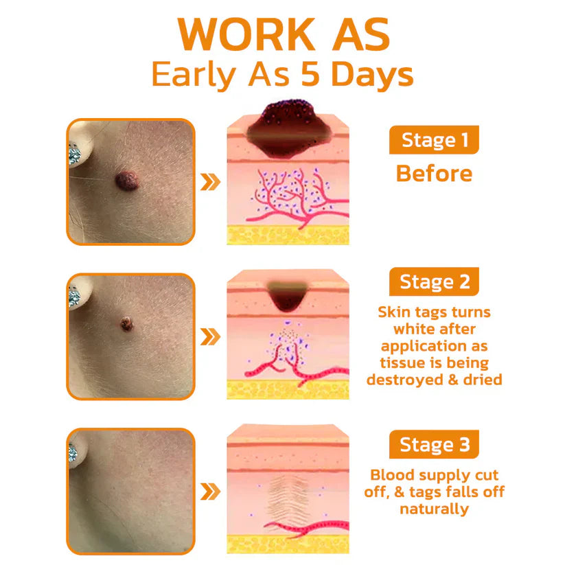 Méhméreg kezelő gél anyajegyekre és szemölcsökre