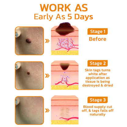 Méhméreg kezelő gél anyajegyekre és szemölcsökre