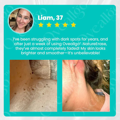 NatureErase Azonnali anyajegy- és folteltávolító gél