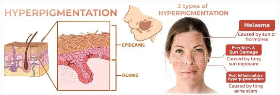 Gyors sötét foltokat eltávolító arcszérum a melanin korrekciójához