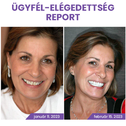 Fogszínkorrektor és zománcápoló szérum ✨